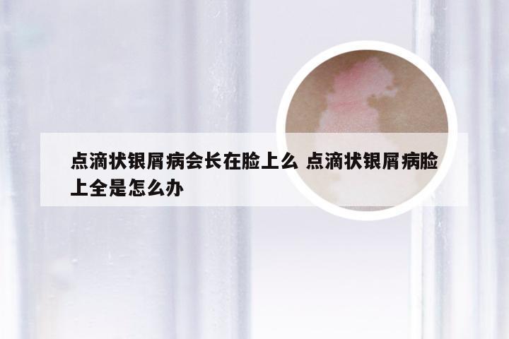 点滴状银屑病会长在脸上么 点滴状银屑病脸上全是怎么办