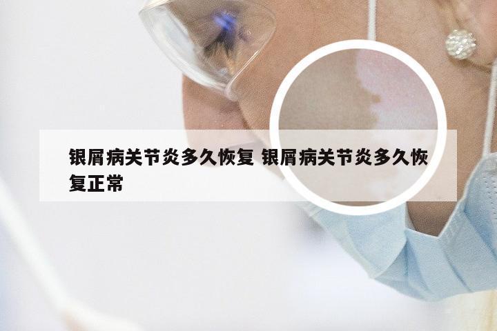 银屑病关节炎多久恢复 银屑病关节炎多久恢复正常