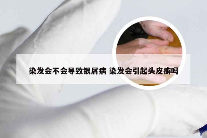 染发会不会导致银屑病 染发会引起头皮癣吗