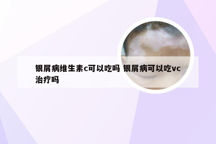 银屑病维生素c可以吃吗 银屑病可以吃vc治疗吗