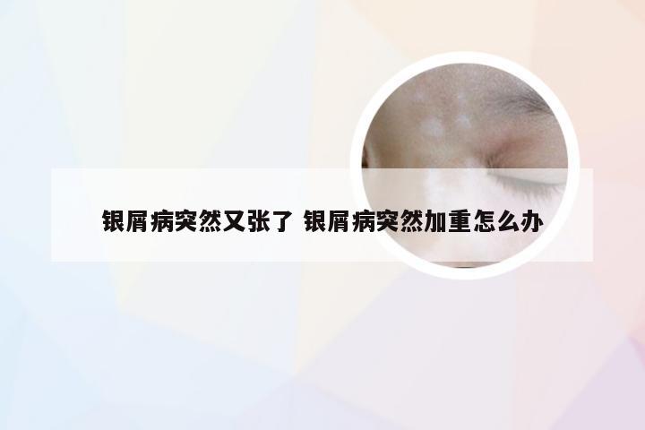 银屑病突然又张了 银屑病突然加重怎么办