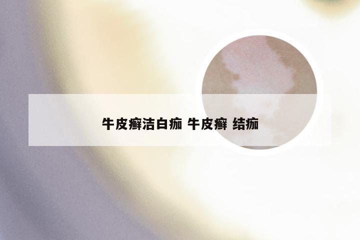 牛皮癣洁白痂 牛皮癣 结痂