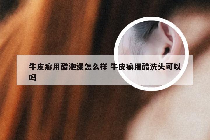牛皮癣用醋泡澡怎么样 牛皮癣用醋洗头可以吗
