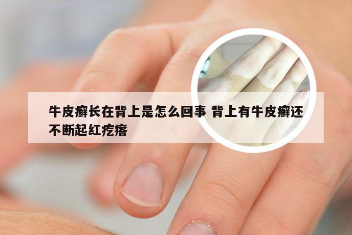 牛皮癣长在背上是怎么回事 背上有牛皮癣还不断起红疙瘩