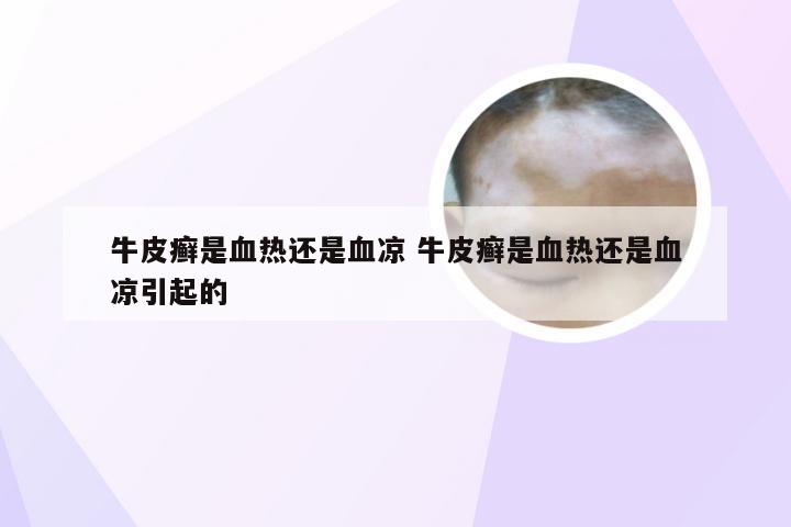 牛皮癣是血热还是血凉 牛皮癣是血热还是血凉引起的
