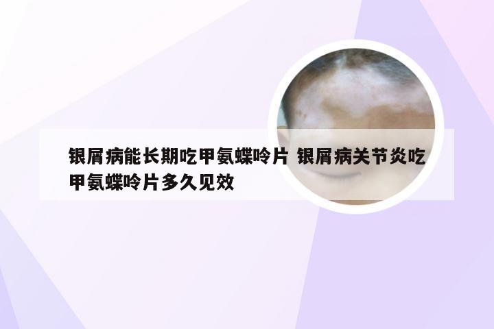 银屑病能长期吃甲氨蝶呤片 银屑病关节炎吃甲氨蝶呤片多久见效