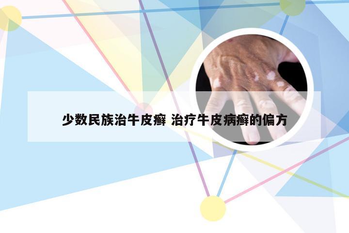 少数民族治牛皮癣 治疗牛皮病癣的偏方