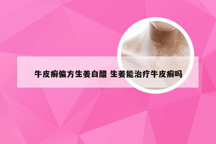 牛皮癣偏方生姜白醋 生姜能治疗牛皮癣吗