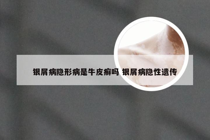 银屑病隐形病是牛皮癣吗 银屑病隐性遗传