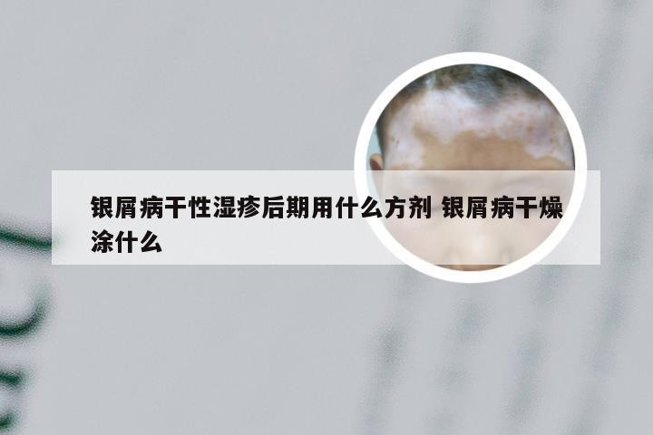 银屑病干性湿疹后期用什么方剂 银屑病干燥涂什么
