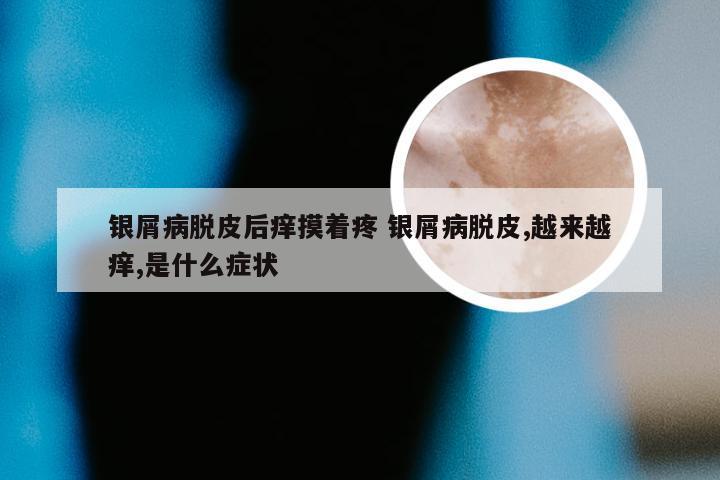 银屑病脱皮后痒摸着疼 银屑病脱皮,越来越痒,是什么症状