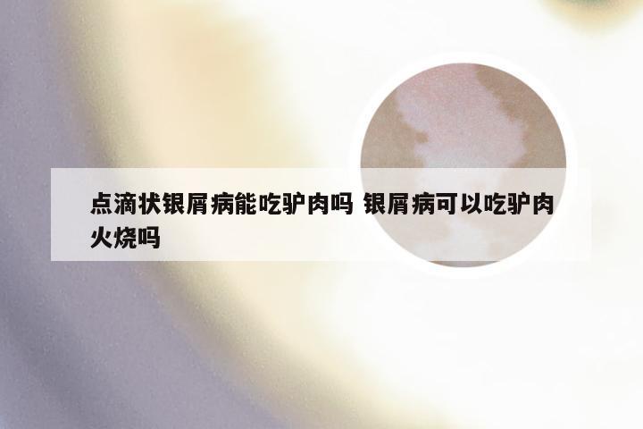 点滴状银屑病能吃驴肉吗 银屑病可以吃驴肉火烧吗