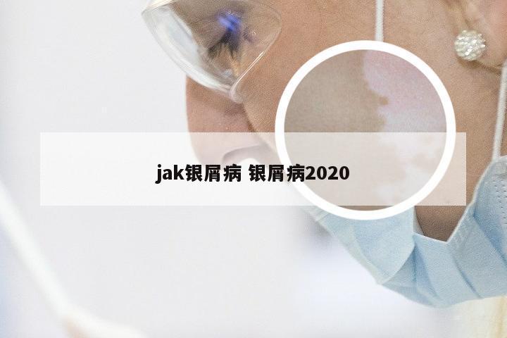jak银屑病 银屑病2020