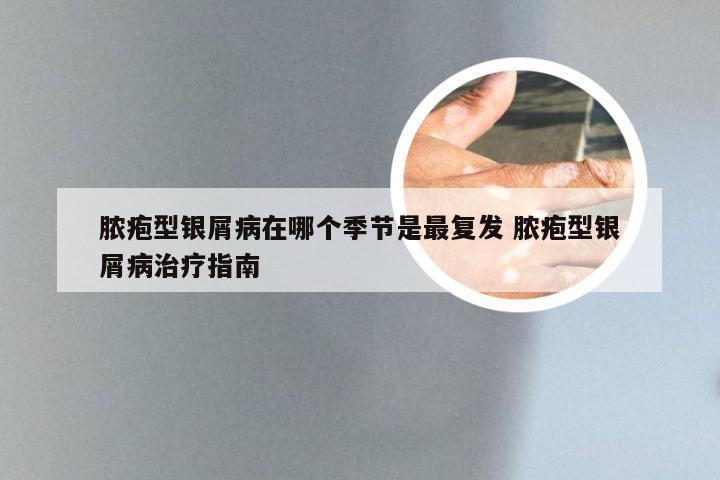 脓疱型银屑病在哪个季节是最复发 脓疱型银屑病治疗指南