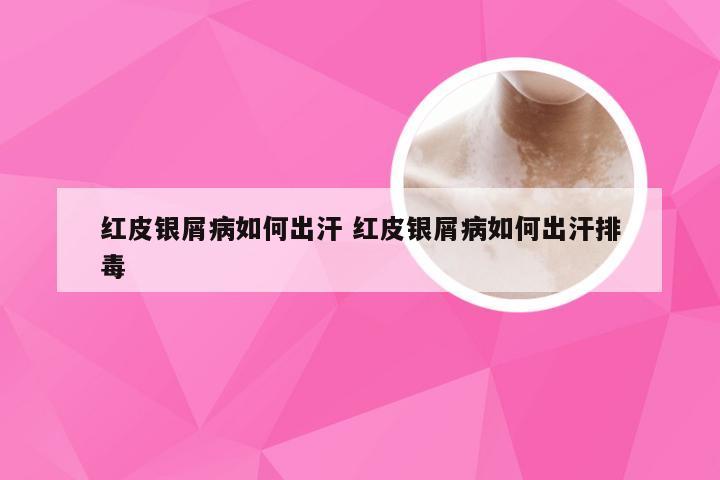 红皮银屑病如何出汗 红皮银屑病如何出汗排毒