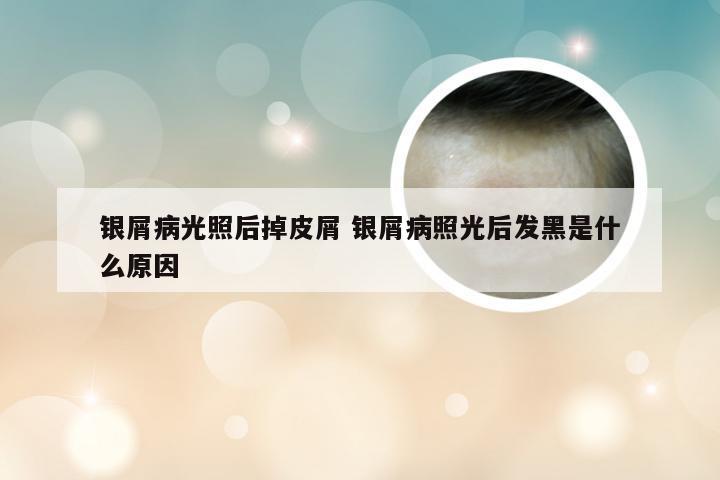 银屑病光照后掉皮屑 银屑病照光后发黑是什么原因