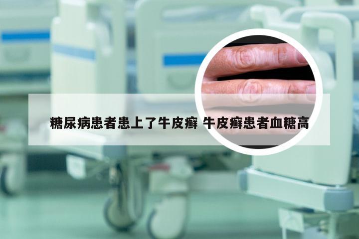 糖尿病患者患上了牛皮癣 牛皮癣患者血糖高