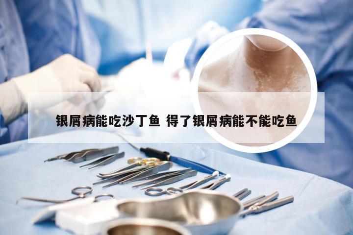 银屑病能吃沙丁鱼 得了银屑病能不能吃鱼