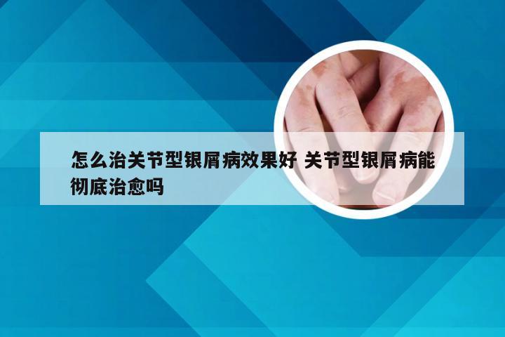 怎么治关节型银屑病效果好 关节型银屑病能彻底治愈吗