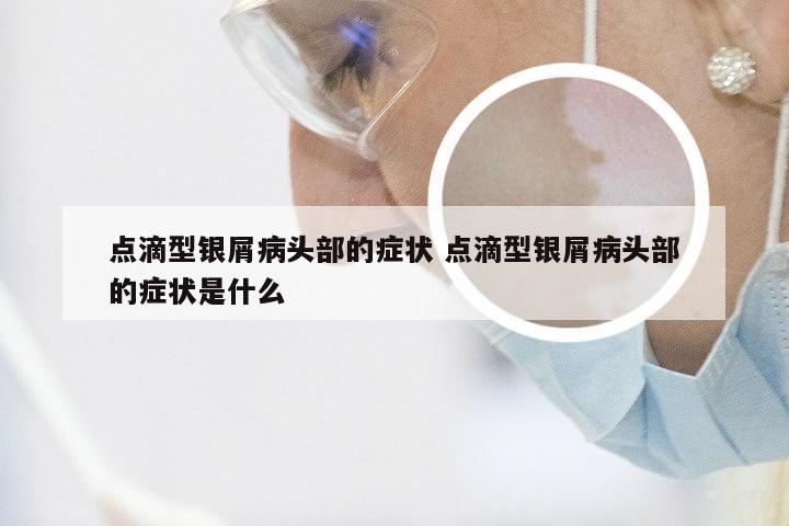 点滴型银屑病头部的症状 点滴型银屑病头部的症状是什么