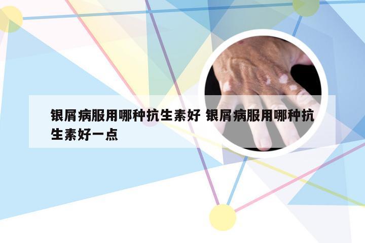 银屑病服用哪种抗生素好 银屑病服用哪种抗生素好一点