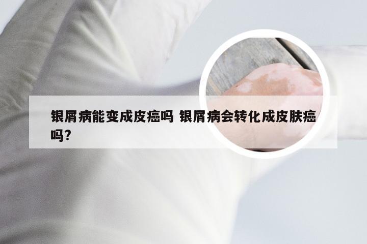 银屑病能变成皮癌吗 银屑病会转化成皮肤癌吗?