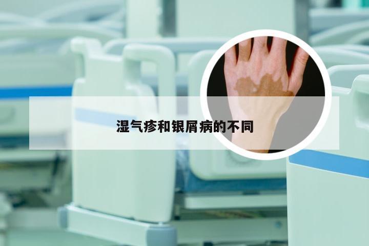 湿气疹和银屑病的不同