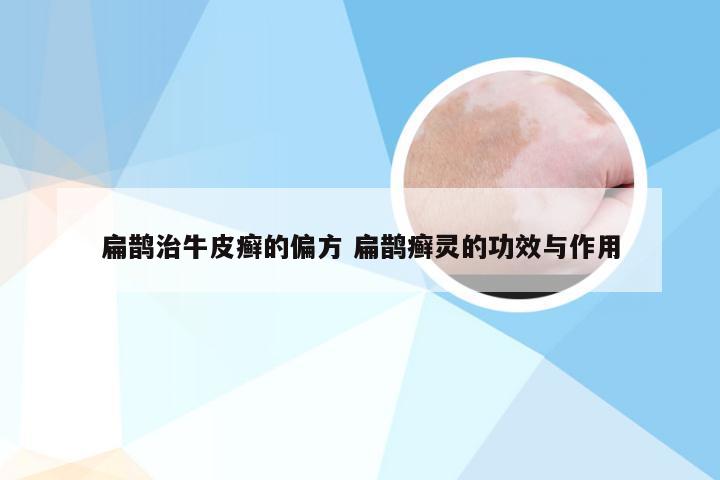 扁鹊治牛皮癣的偏方 扁鹊癣灵的功效与作用