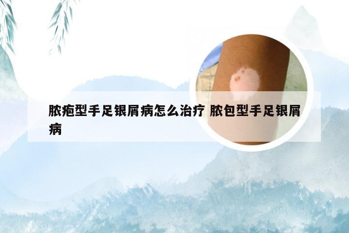 脓疱型手足银屑病怎么治疗 脓包型手足银屑病