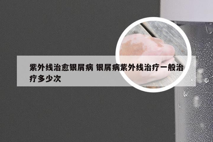 紫外线治愈银屑病 银屑病紫外线治疗一般治疗多少次