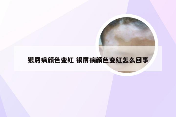 银屑病颜色变红 银屑病颜色变红怎么回事