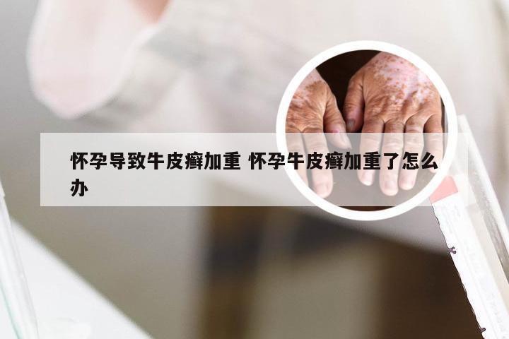 怀孕导致牛皮癣加重 怀孕牛皮癣加重了怎么办