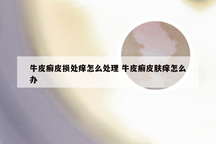 牛皮癣皮损处痒怎么处理 牛皮癣皮肤痒怎么办