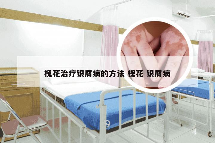 槐花治疗银屑病的方法 槐花 银屑病