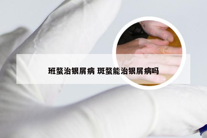 班蝥治银屑病 斑蝥能治银屑病吗