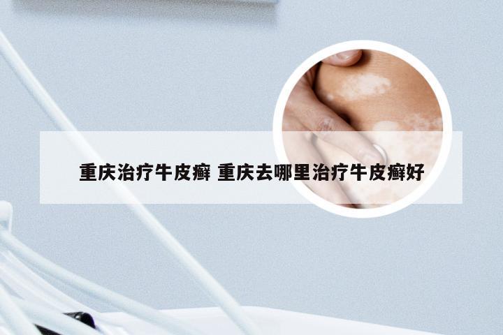重庆治疗牛皮癣 重庆去哪里治疗牛皮癣好