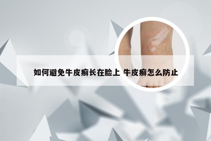 如何避免牛皮癣长在脸上 牛皮癣怎么防止