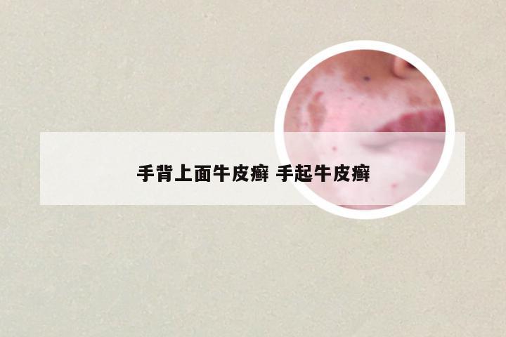 手背上面牛皮癣 手起牛皮癣