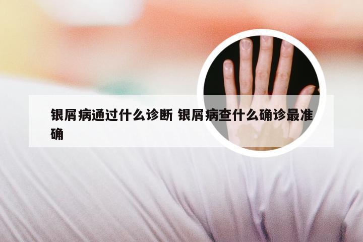 银屑病通过什么诊断 银屑病查什么确诊最准确