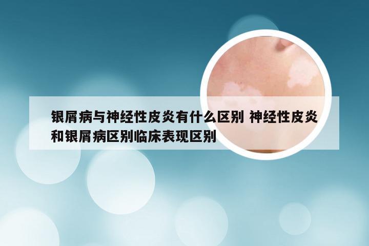 银屑病与神经性皮炎有什么区别 神经性皮炎和银屑病区别临床表现区别