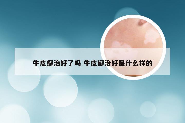 牛皮癣治好了吗 牛皮癣治好是什么样的