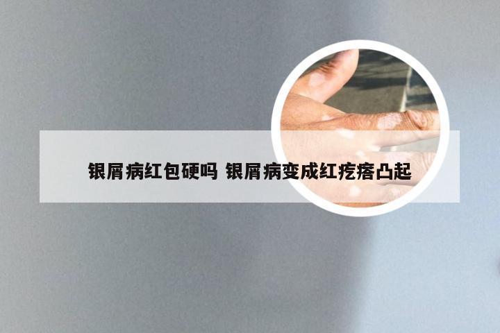 银屑病红包硬吗 银屑病变成红疙瘩凸起