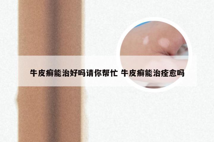 牛皮癣能治好吗请你帮忙 牛皮癣能治痊愈吗