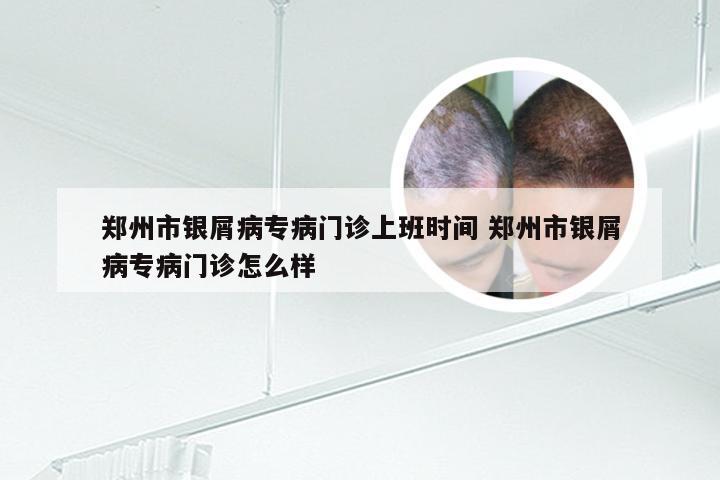 郑州市银屑病专病门诊上班时间 郑州市银屑病专病门诊怎么样