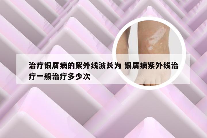 治疗银屑病的紫外线波长为 银屑病紫外线治疗一般治疗多少次