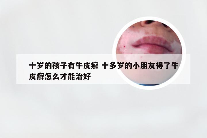 十岁的孩子有牛皮癣 十多岁的小朋友得了牛皮癣怎么才能治好