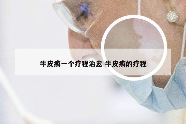 牛皮癣一个疗程治愈 牛皮癣的疗程