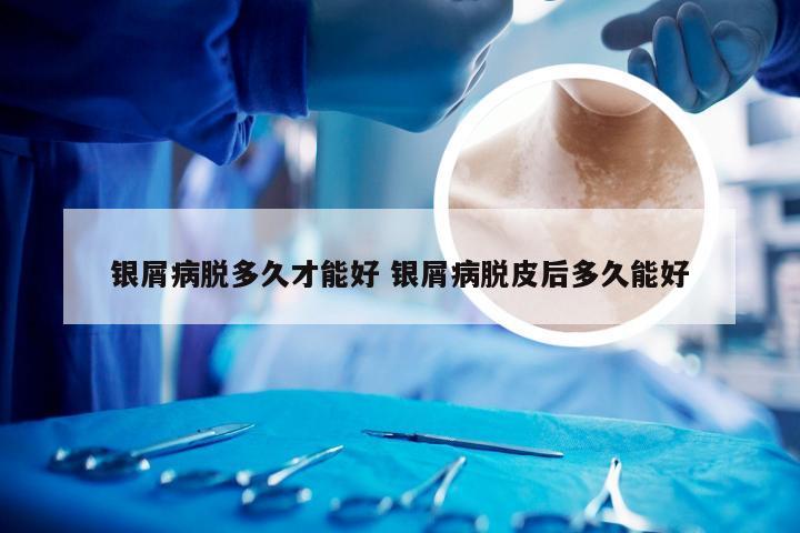 银屑病脱多久才能好 银屑病脱皮后多久能好
