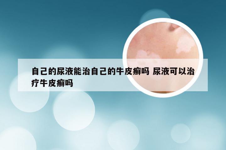 自己的尿液能治自己的牛皮癣吗 尿液可以治疗牛皮癣吗