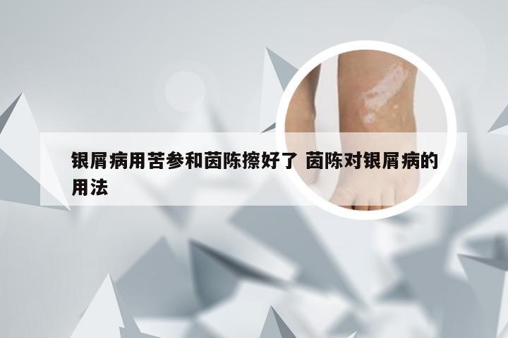 银屑病用苦参和茵陈擦好了 茵陈对银屑病的用法